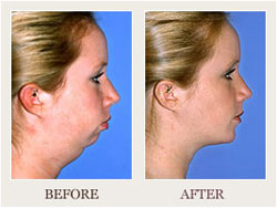 Jaw Surgery