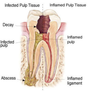 Root Canal Treatment Delhi