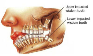 Wisdom Tooth