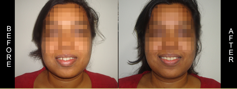 Before Cosmetic Treatment