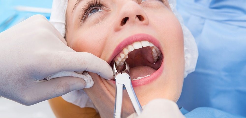 Tooth Removal