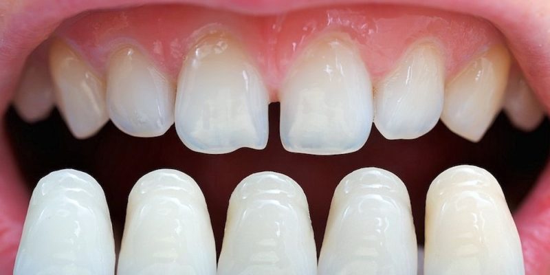 Dental-Veneers