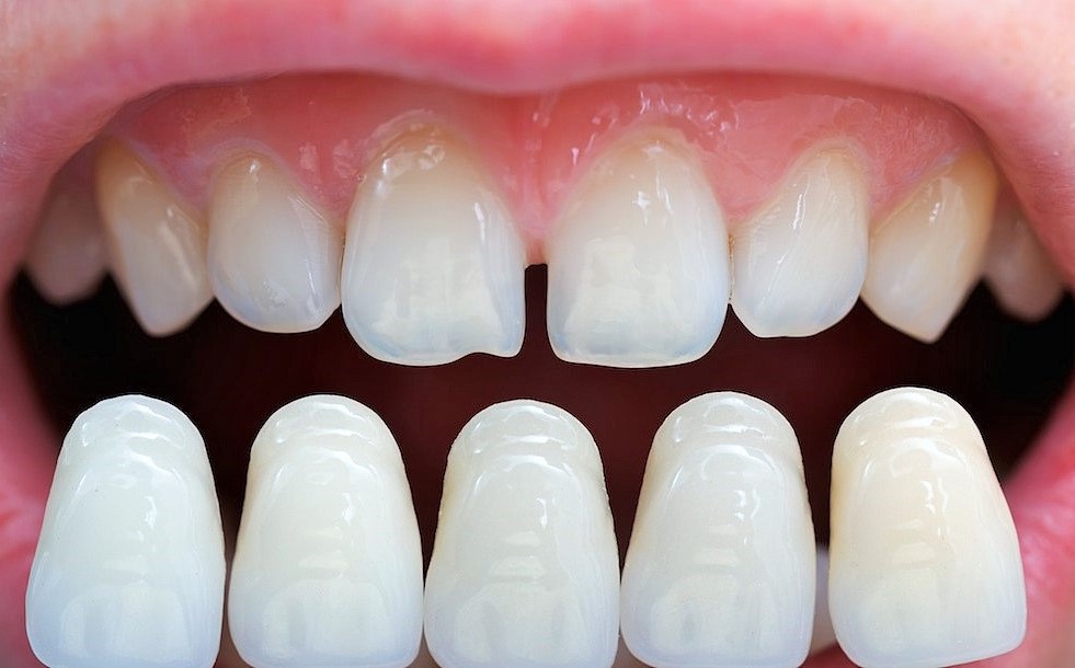 Dental-Veneers