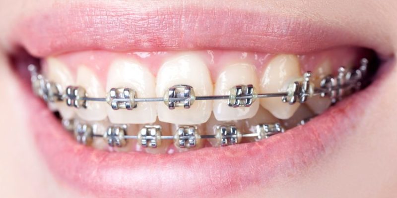 Dental Braces