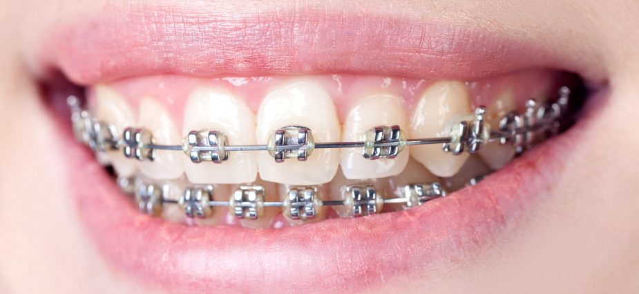 Dental Braces